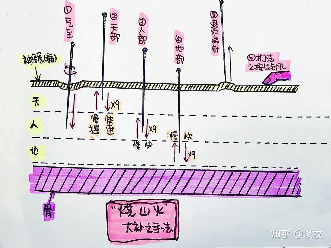 人纪针灸笔记(19)针刺法 - 知乎