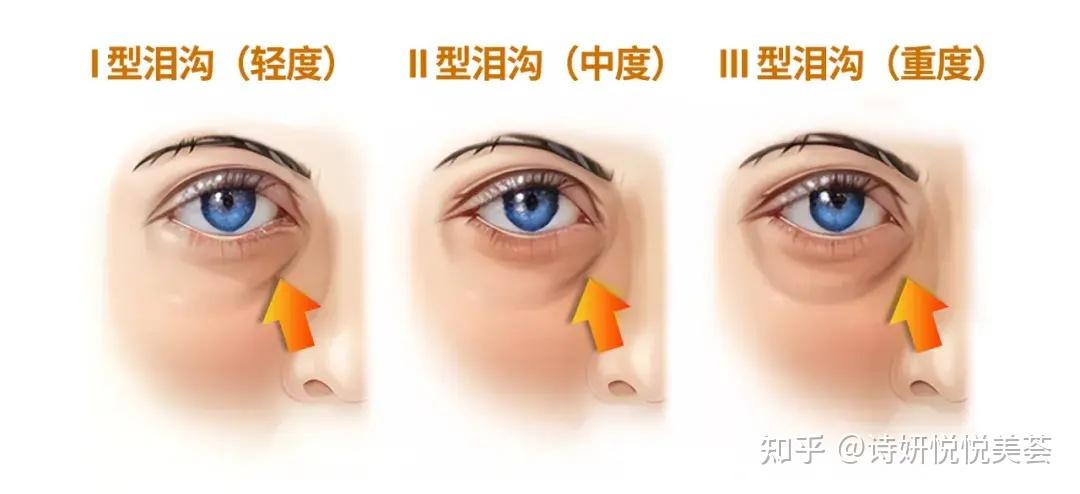 泪沟凹陷改善思路,让你秒变“水灵眼” - 知乎