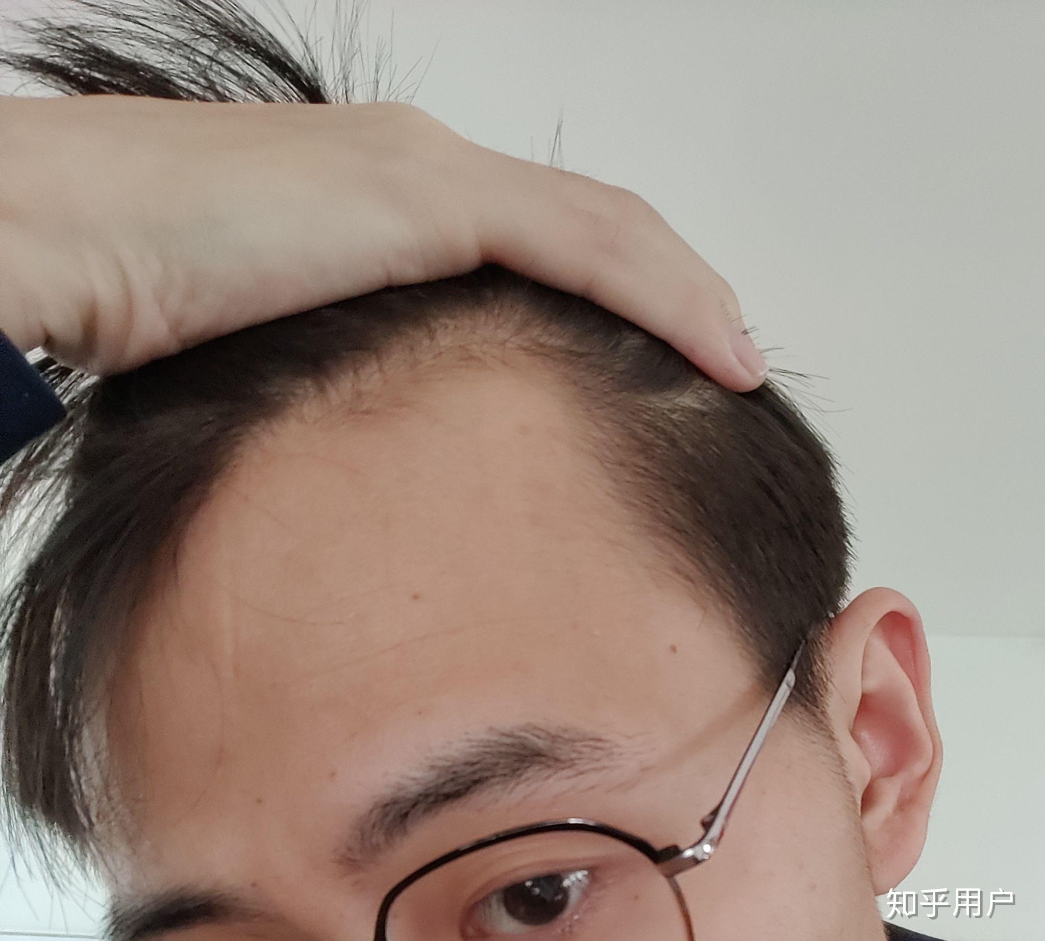 20多岁的男生有一个m型发际线是怎样的体验