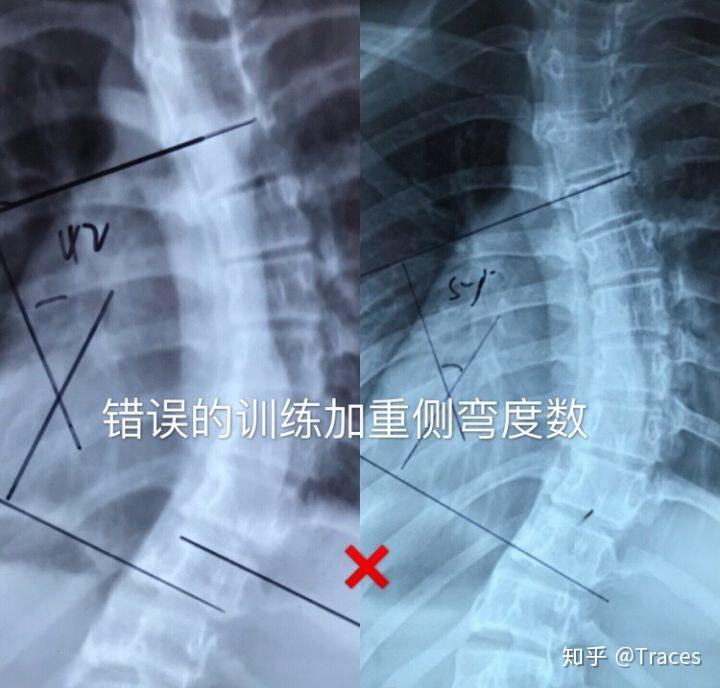 彎友找到北京某醫院牽引按摩或物理矯正2個多月,cobb角加重10幾度