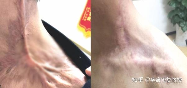 烧烫伤疤痕怎么办?可以除掉吗?你一定要知道的事! - 知乎