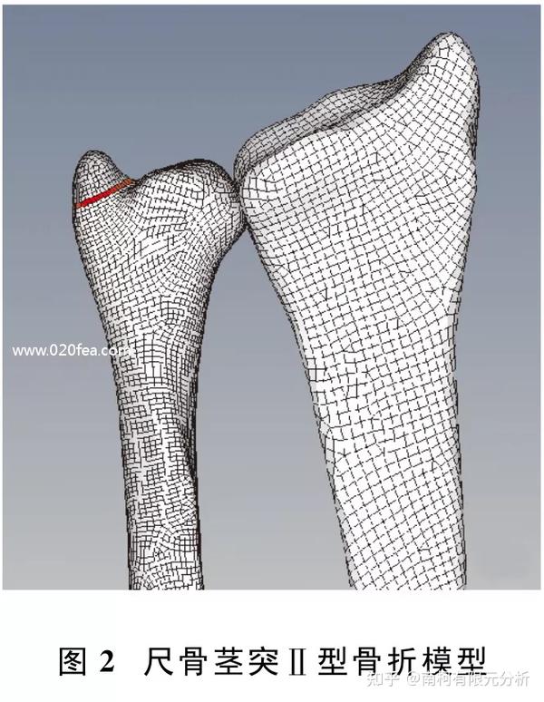 尺骨茎突骨折的建模和生物力学分析 知乎