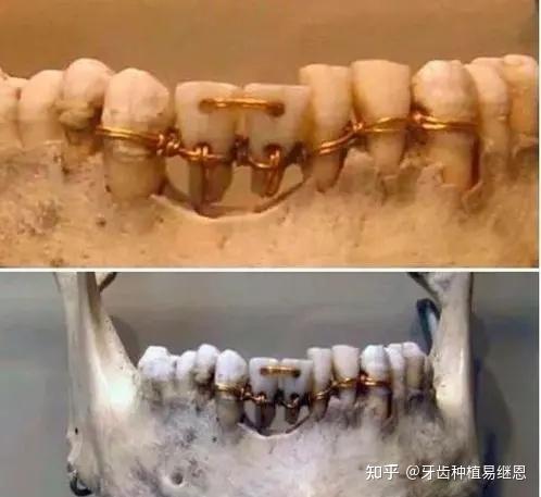古人也做牙齿矫正？对牙齿美观和功能的需求不分古今，长沙中诺口腔医院助您重拾美貌！ - 知乎