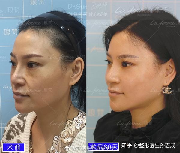 自测一下你属于哪种法令纹? - 知乎