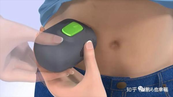 美敦力guardian德康g6及雅培瞬感哪家强