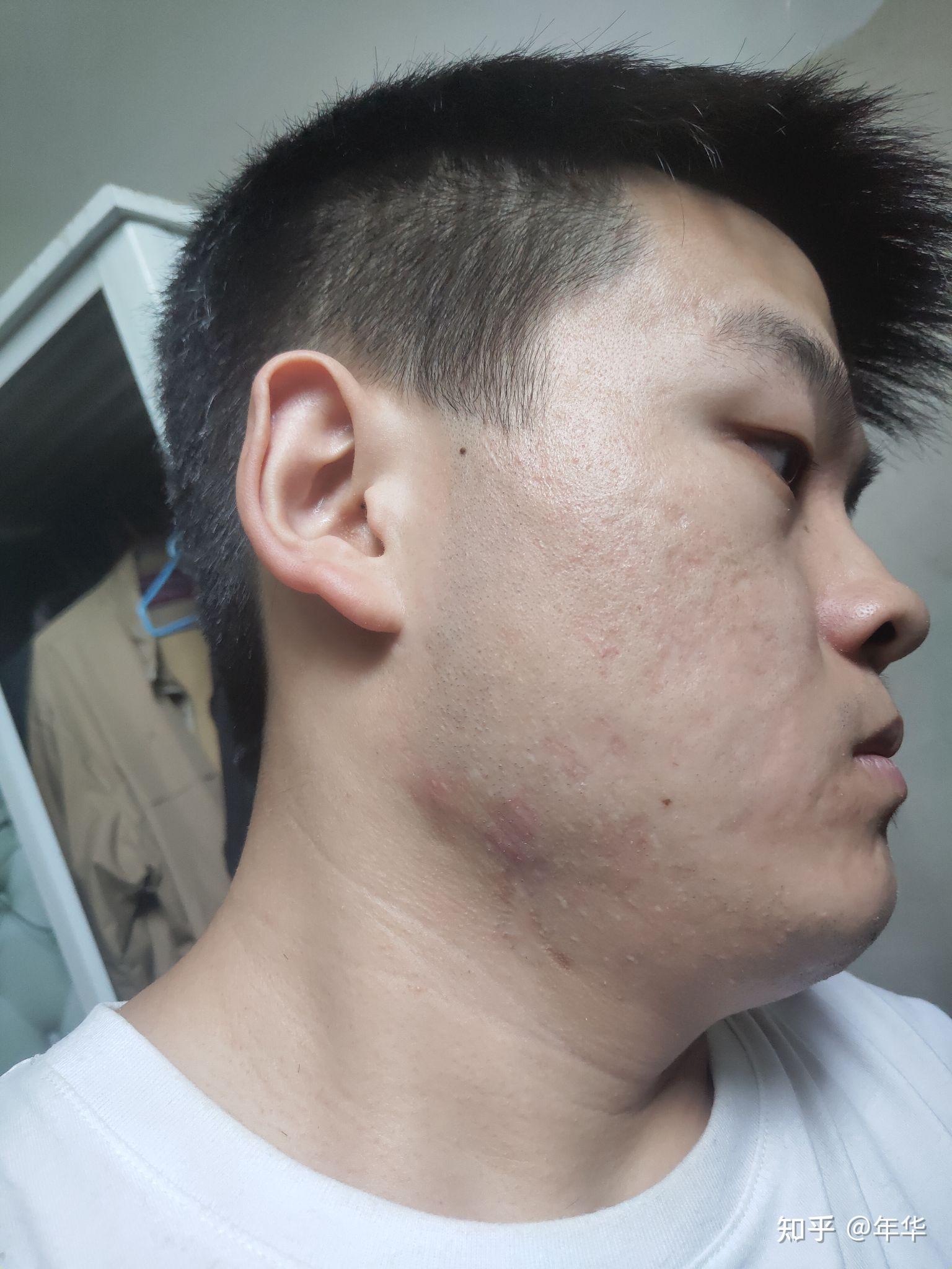 痤疮引起的我的增生性瘢痕恢复之路