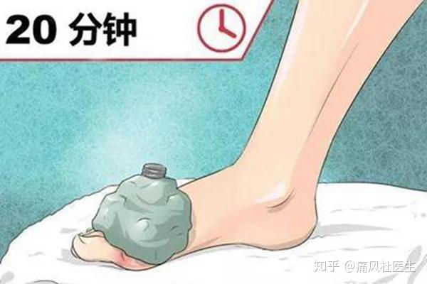 教你5招缓解痛风的方法 知乎