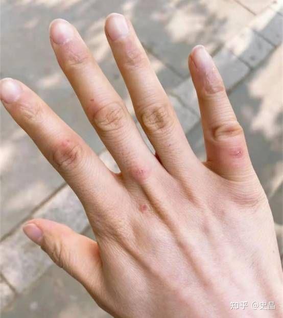 冻脚脚冷怎么办