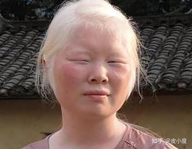 中国白化病人的图片图片