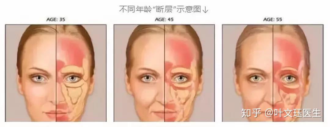 抗衰效果即刻见效中老年人:年龄大肌肉萎缩,搭配线雕面部年轻化效果