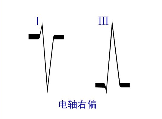 在家测出心电轴右偏怎么办 知乎