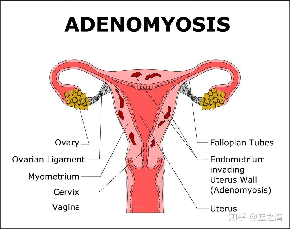 维生素d缺乏和肥胖导致不孕不育的两大元凶