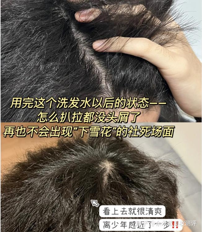 用什么洗头可以减少头皮屑?去屑又止痒的洗发水排行 - 知乎