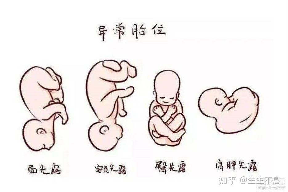 loa胎位是好是坏看完就明白了! - 知乎