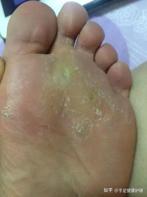 脚垫?胼胝?鸡眼?跖疣?刺猴?傻傻分不清? - 知乎