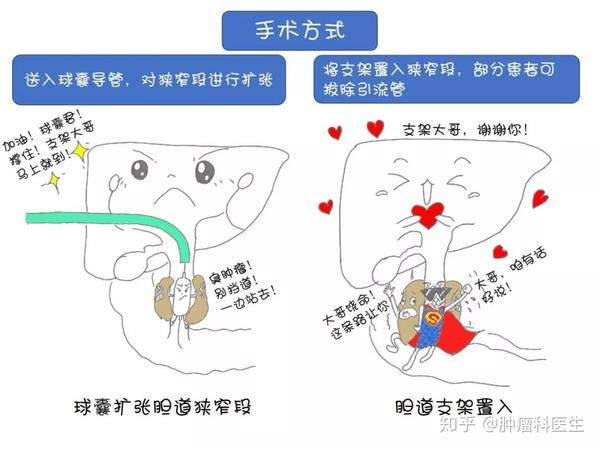 漫画版胆道置管引流围手术期护理及健康宣教