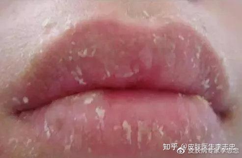 中医是如何解析和治疗唇炎的 知乎