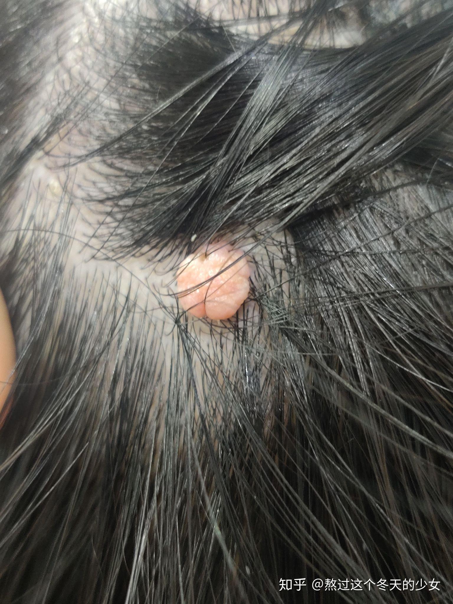 头皮上皮脂腺瘤图片图片