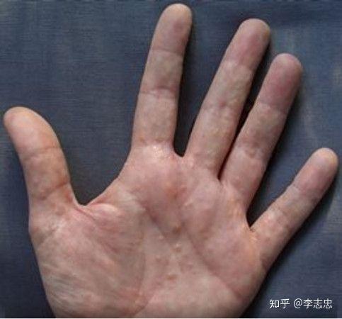 每年夏天手指长水泡 又特别痒 八成是汗疱疹来袭 知乎