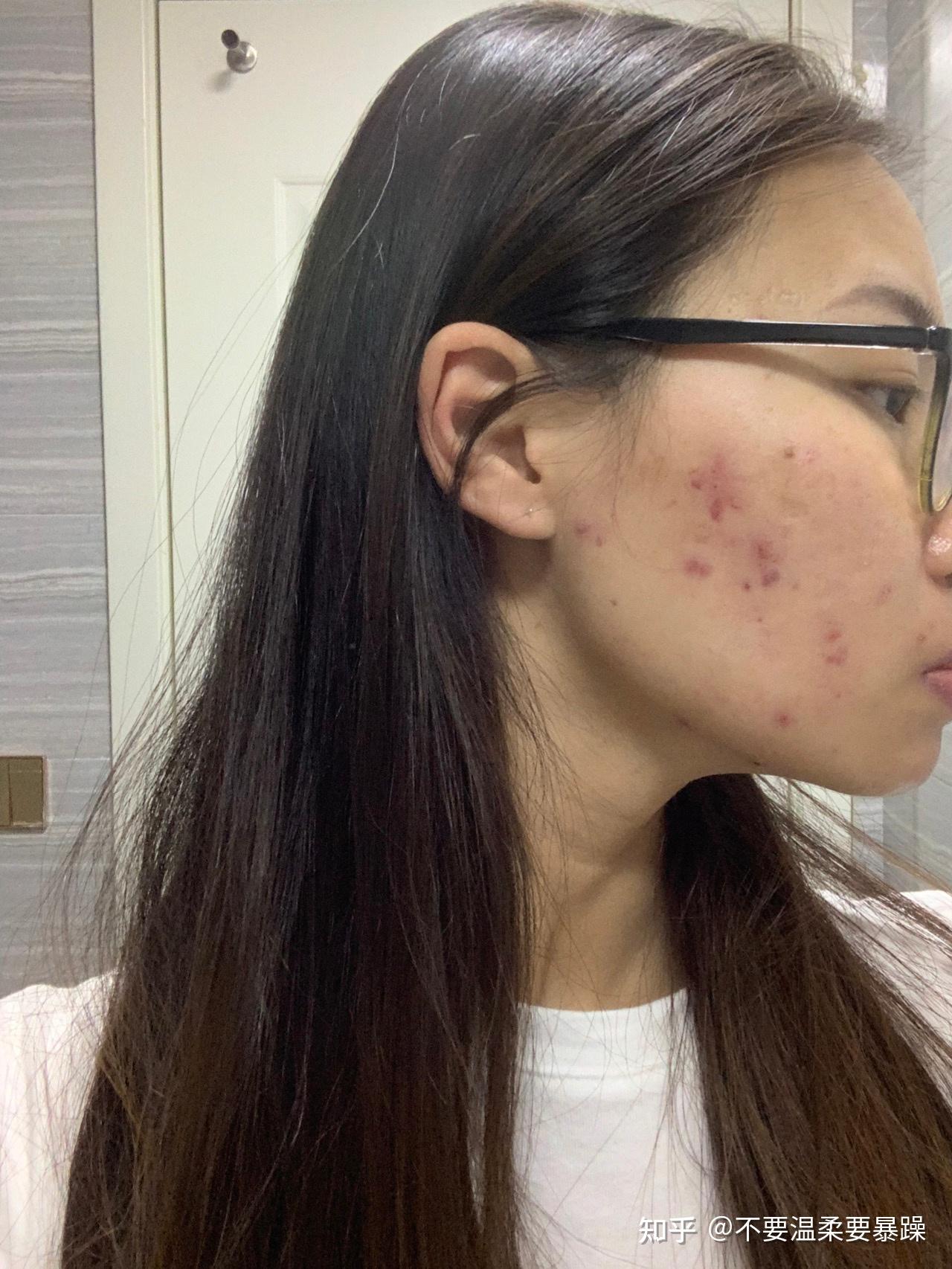 你们试过最牛逼的去痘印方法是什么? - 知乎