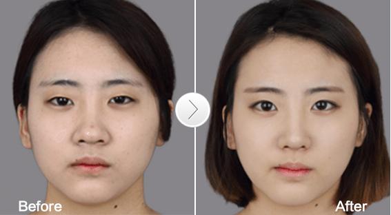 鼻翼缩小术娇俏美鼻缩出来