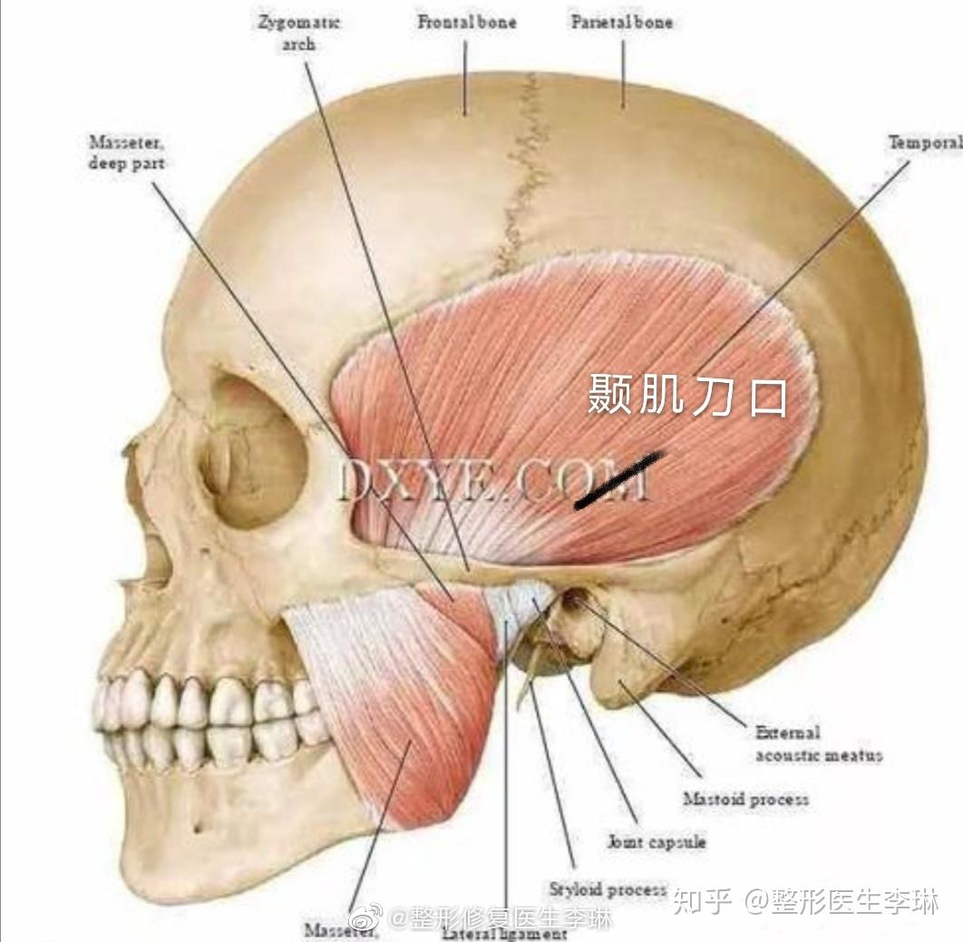 图2 颞肌切口,通过此切口至颞骨骨膜下,并向前剥离手术方法:1.