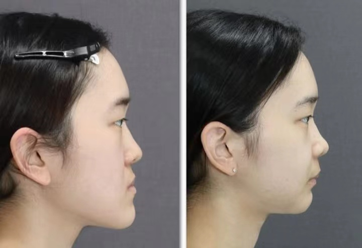 vvsmile隐形矫正能改变脸型吗这三种变化太大了