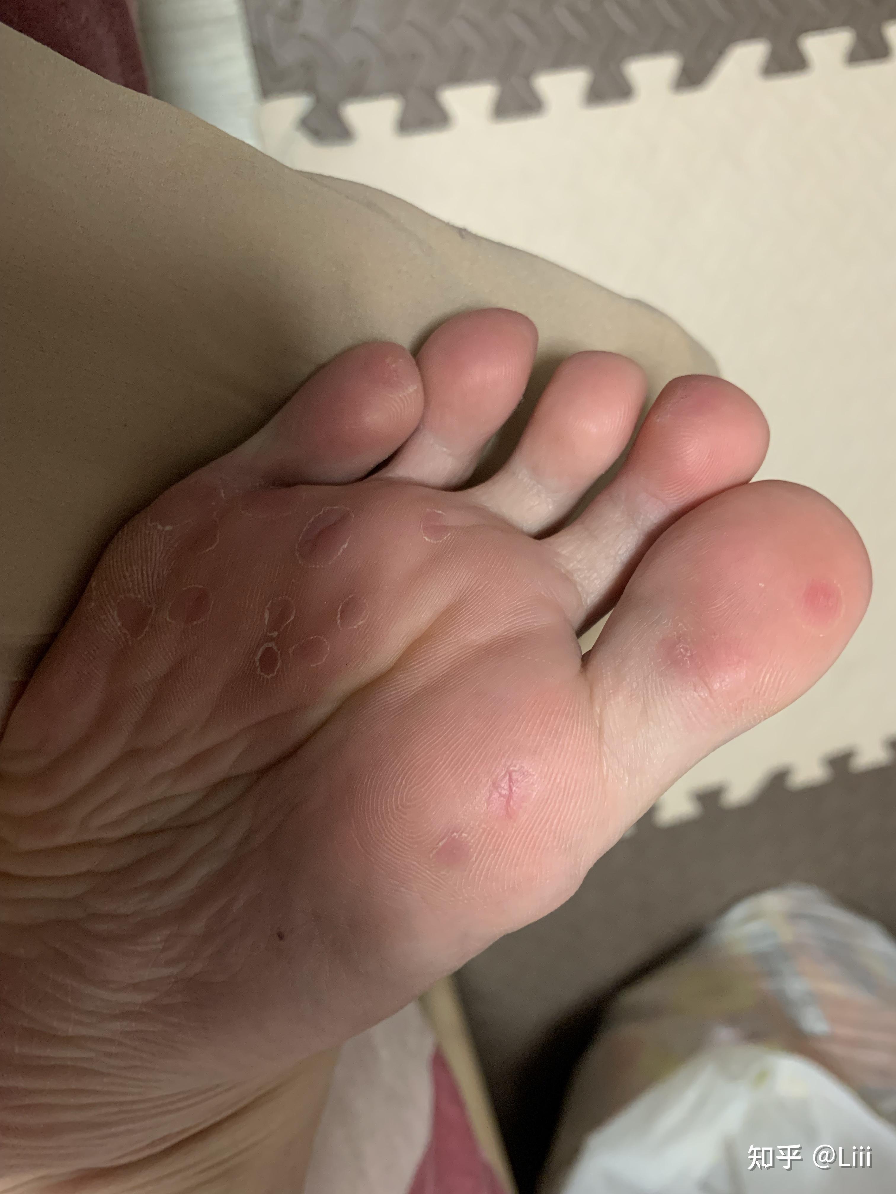 趾疣治疗过程记录