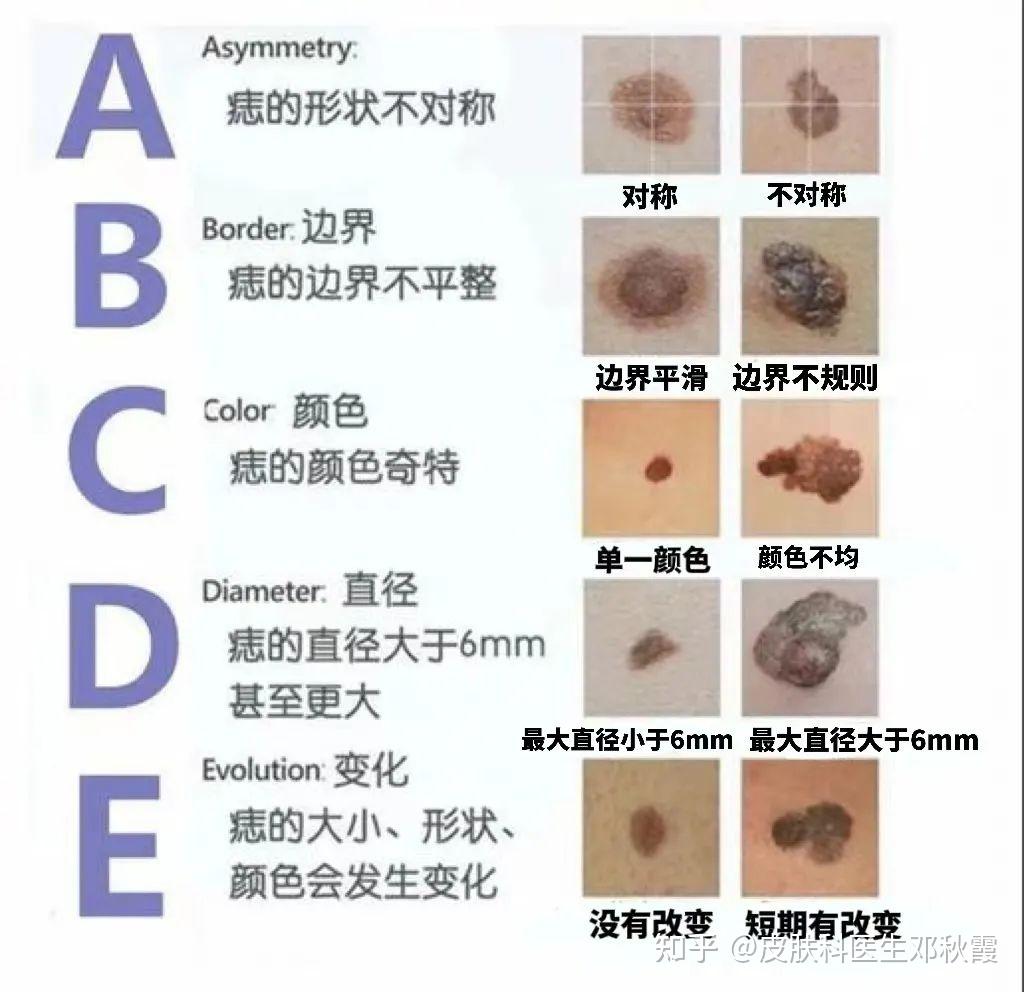 大家可以根据 abcde 法自我初步判断,是不是符合这 5 种特征:黑色