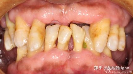 重度牙周炎治疗日记
