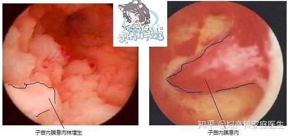 了解了正常子宫内膜和正常子宫腔的宫腔镜图像,我们就可以学习辨别