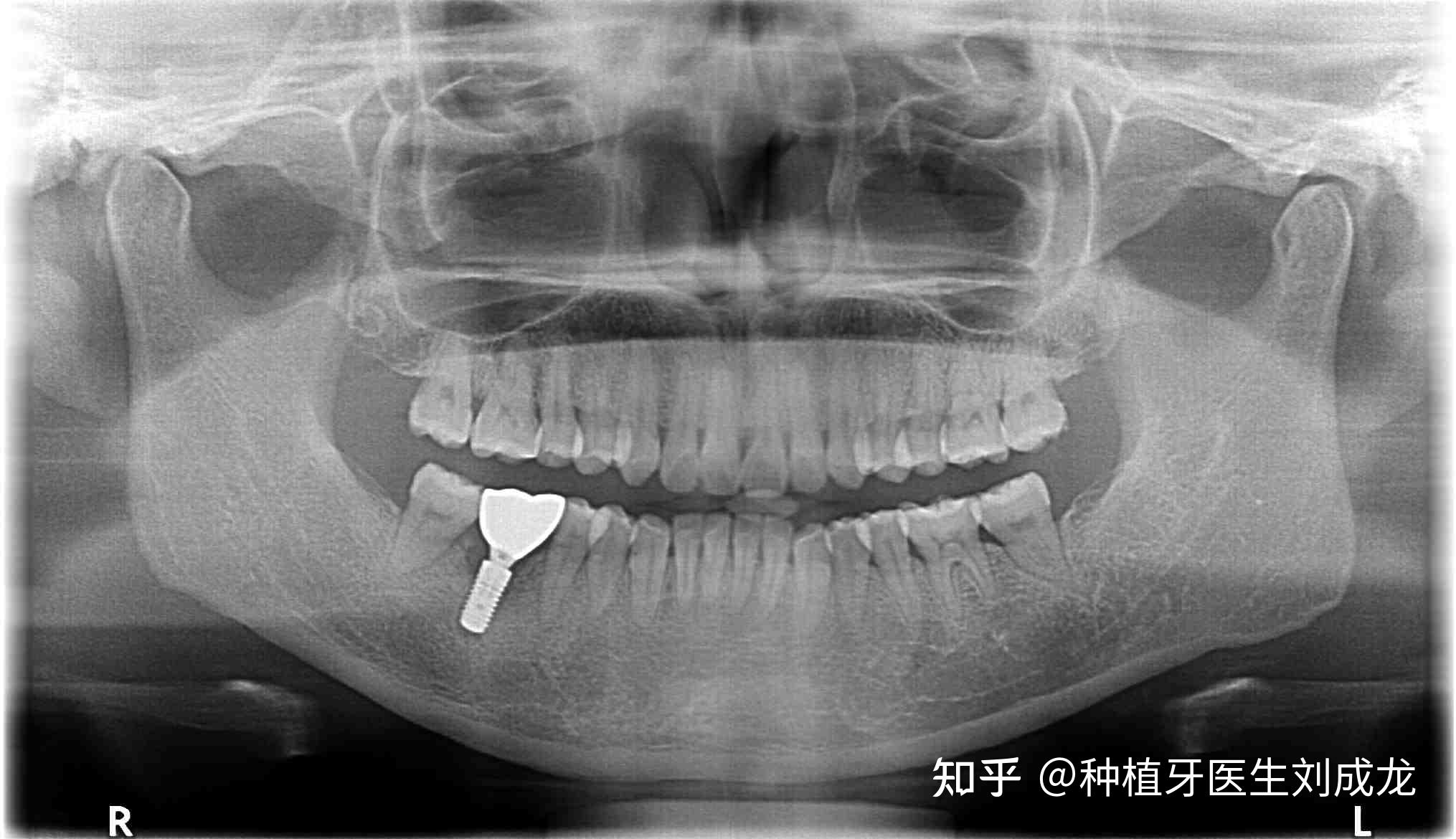 郑州瑞士iti种植牙医生刘成龙41岁女士磨牙区单颗种植案例