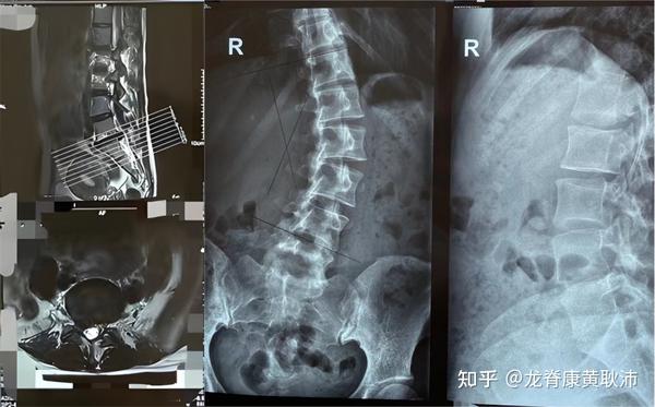 腰椎侧弯为何容易引起腰椎间盘突出？该如何应对？详细回答您 知乎