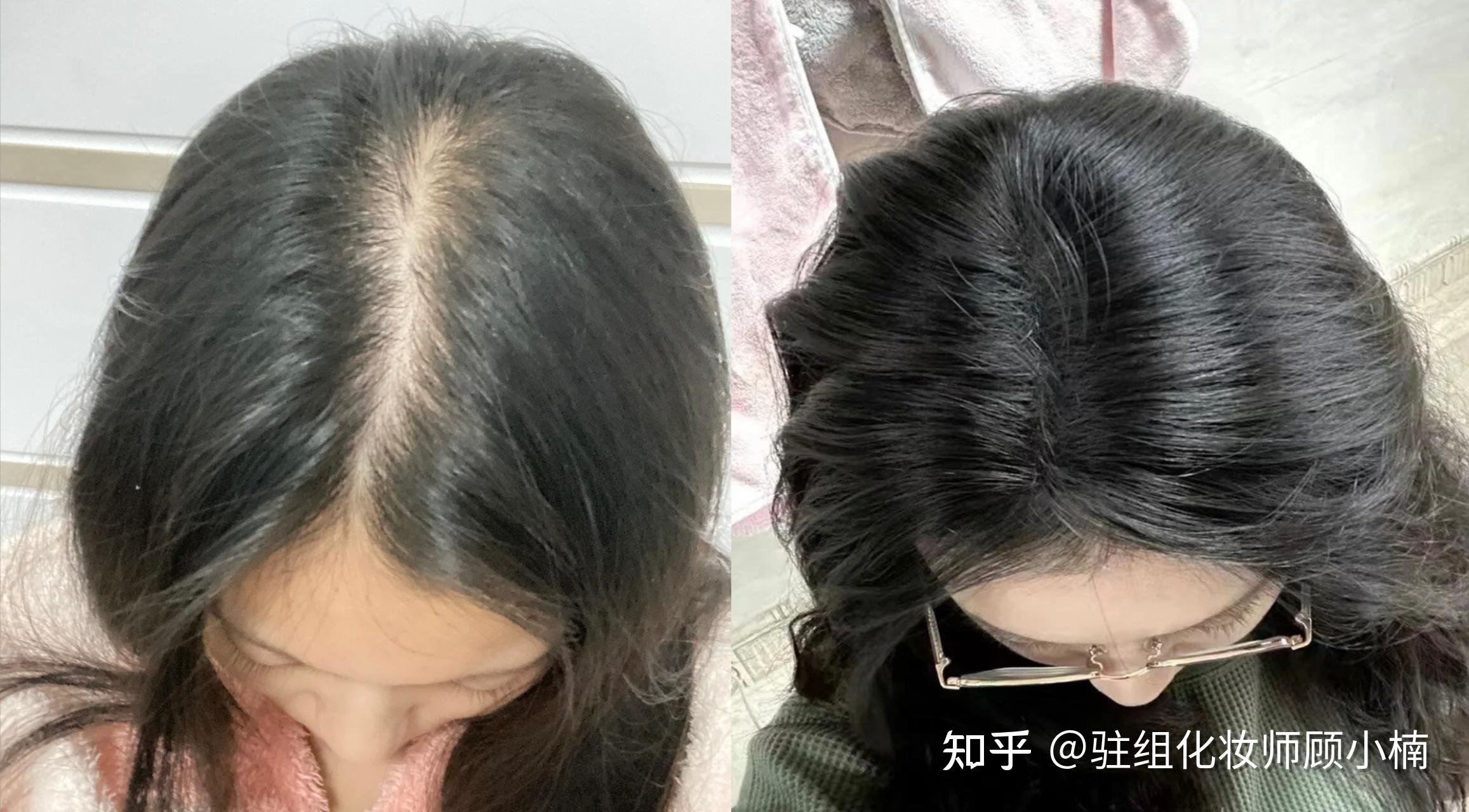 防脱洗发水都用遍了,为什么头发还是掉一堆,发缝宽成通天河,枕头上下水道都是头发?有什么好用的办法吗? - 知乎