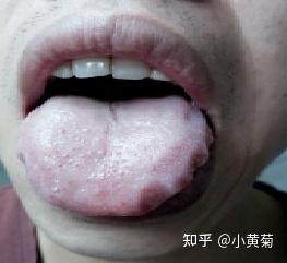 一份红一份热——“点刺舌”舌象 - 知乎