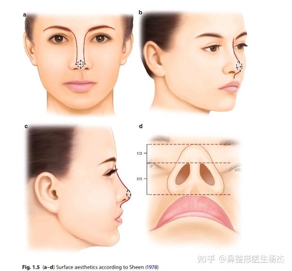 鼻整形的天花板:鼻孔整形 - 知乎