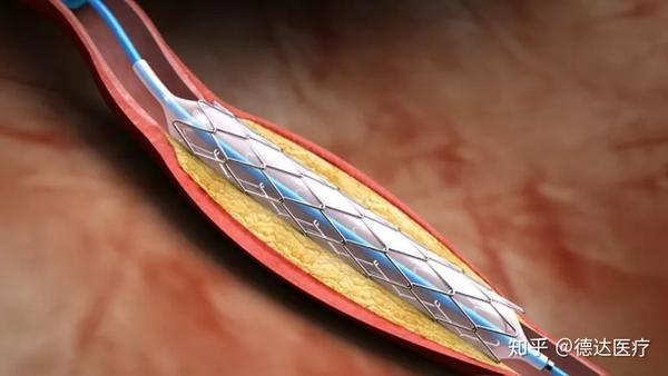 一年病危n次高危冠心病患者该如何与时间赛跑