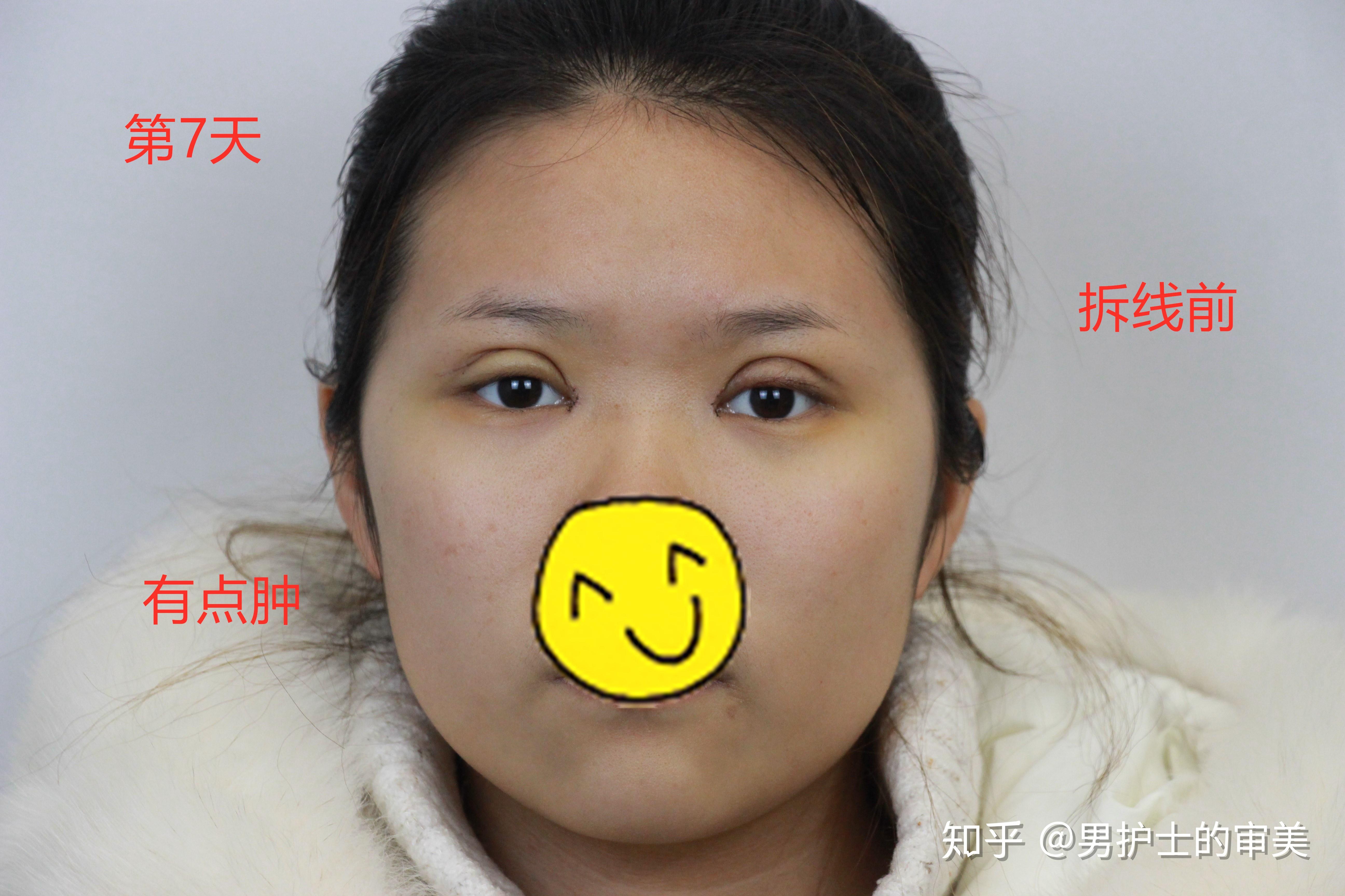 河南姑娘脂肪型肉眼泡明显全切扇形双眼皮后双眼皮自然流畅