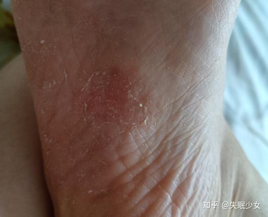 脱皮型脚气怎样根治