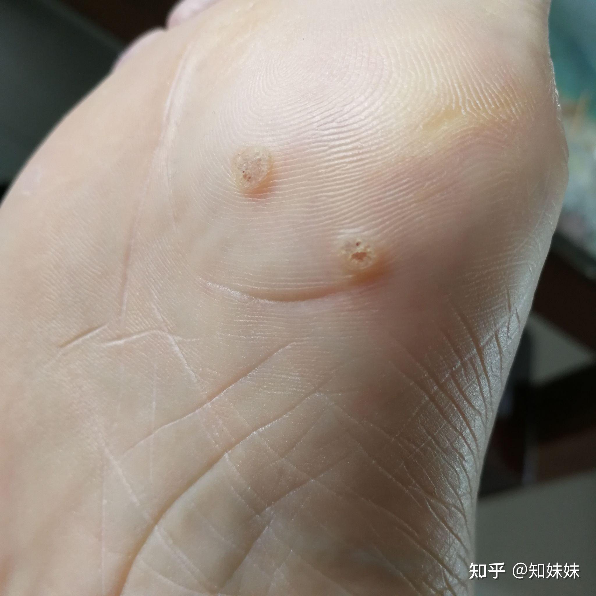 我的治疗跖疣经历