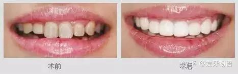 洗牙能让牙变白吗