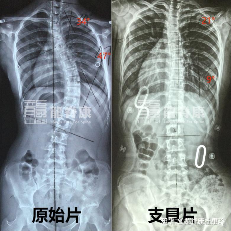 15岁女孩坚持治疗1年,脊柱侧弯从47°矫正至21°! - 知乎