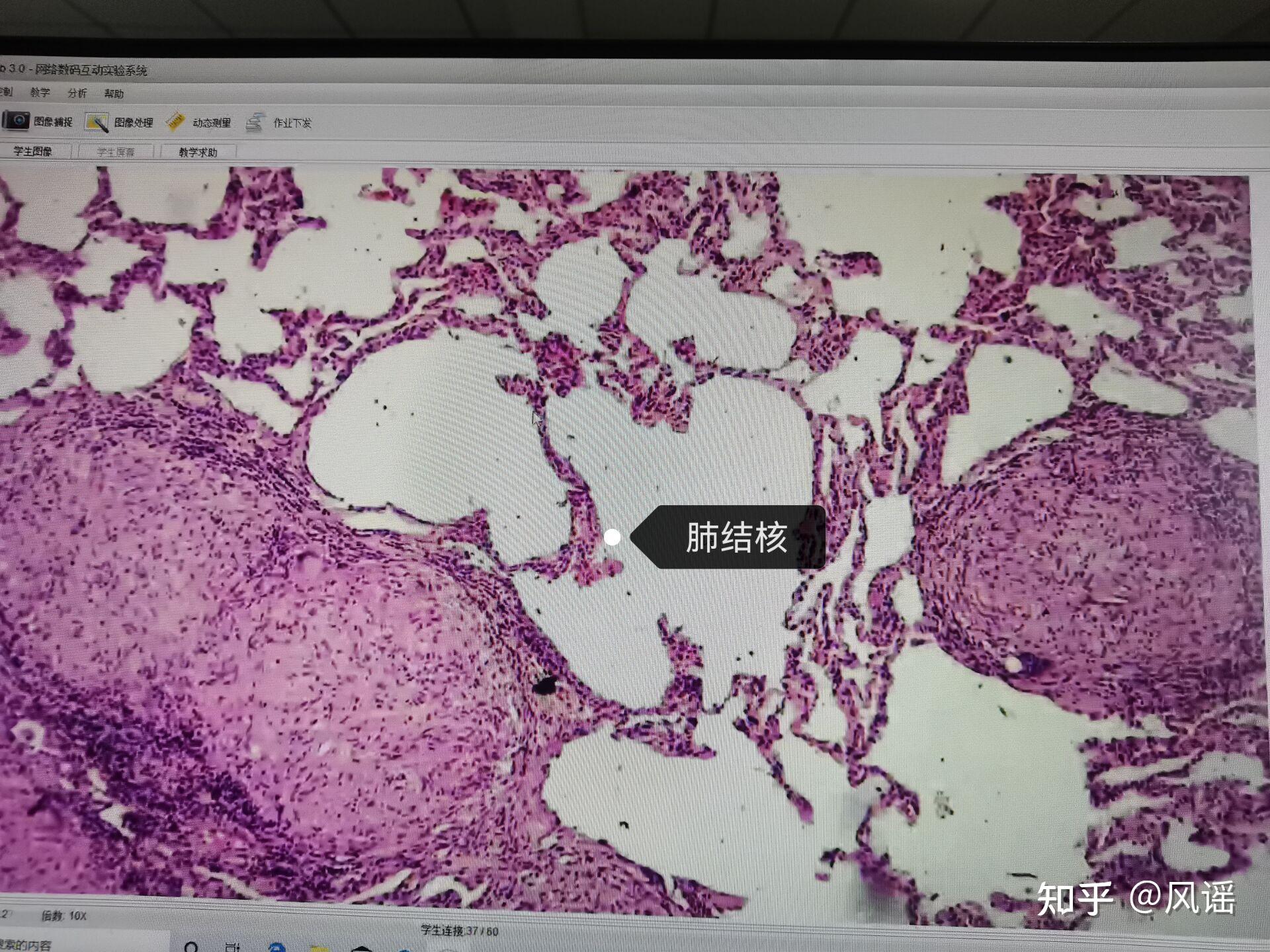 图2—32 急性血行播散性肺结核-胸部X线影像学图鉴-医学