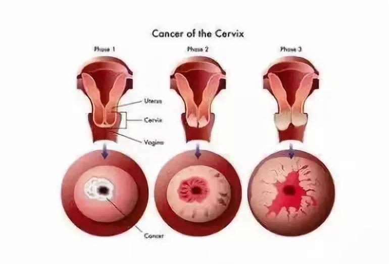 宫颈炎会变成宫颈癌吗图片