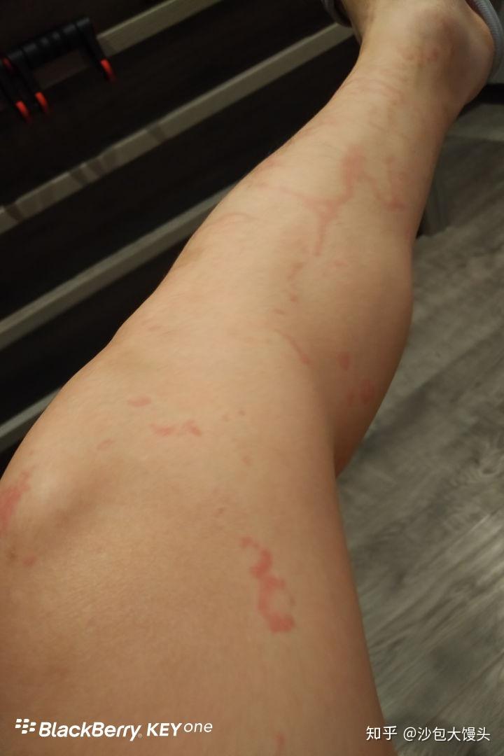 水土不服从过敏性鼻炎到荨麻疹的痛苦治疗之路