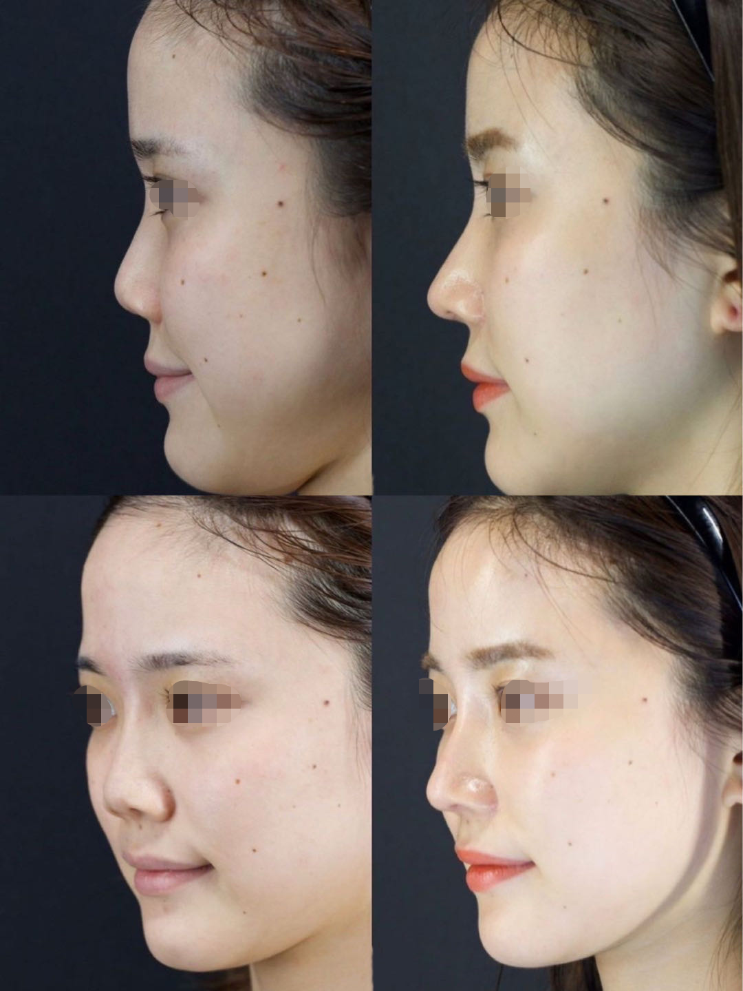 越来越多的隆鼻整形失败 是因为什么原因导致的 如何避免 知乎 越来越多的隆鼻整形失败 是因为什么原因导致的 如何避免 知乎
