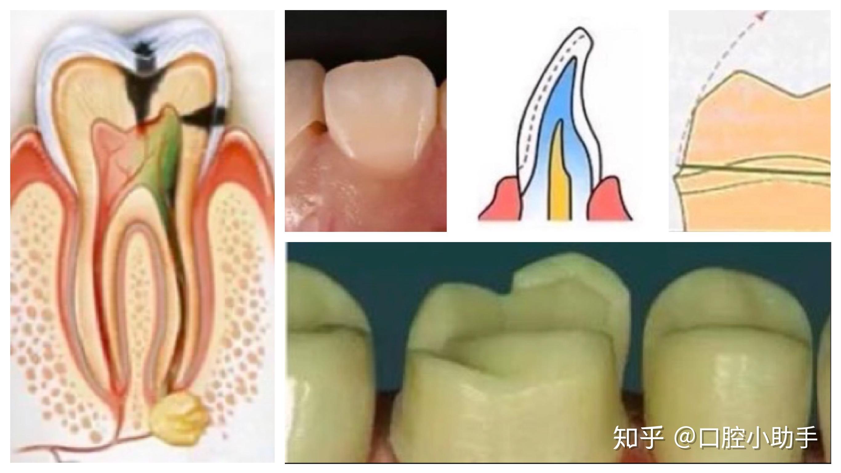 修复体边缘1    标准的预备体应具备什么:边缘线&龈缘线位置合适;肩台