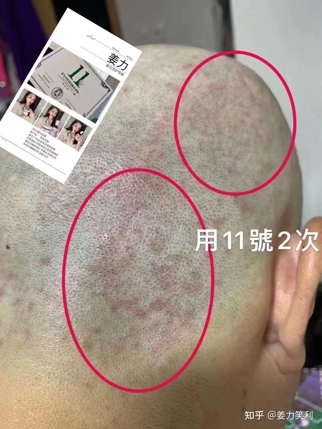 头皮痒的都抓破了还有大量头皮屑怎么办啊