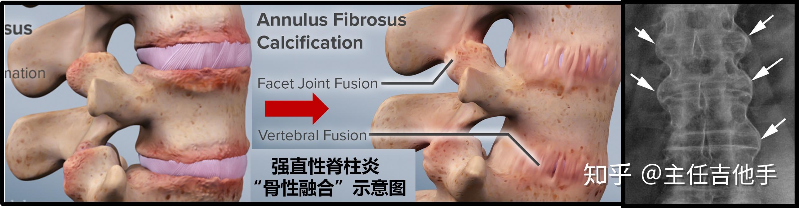 何謂強直性脊柱炎,是怎麼得的?(連載-2) - 知乎