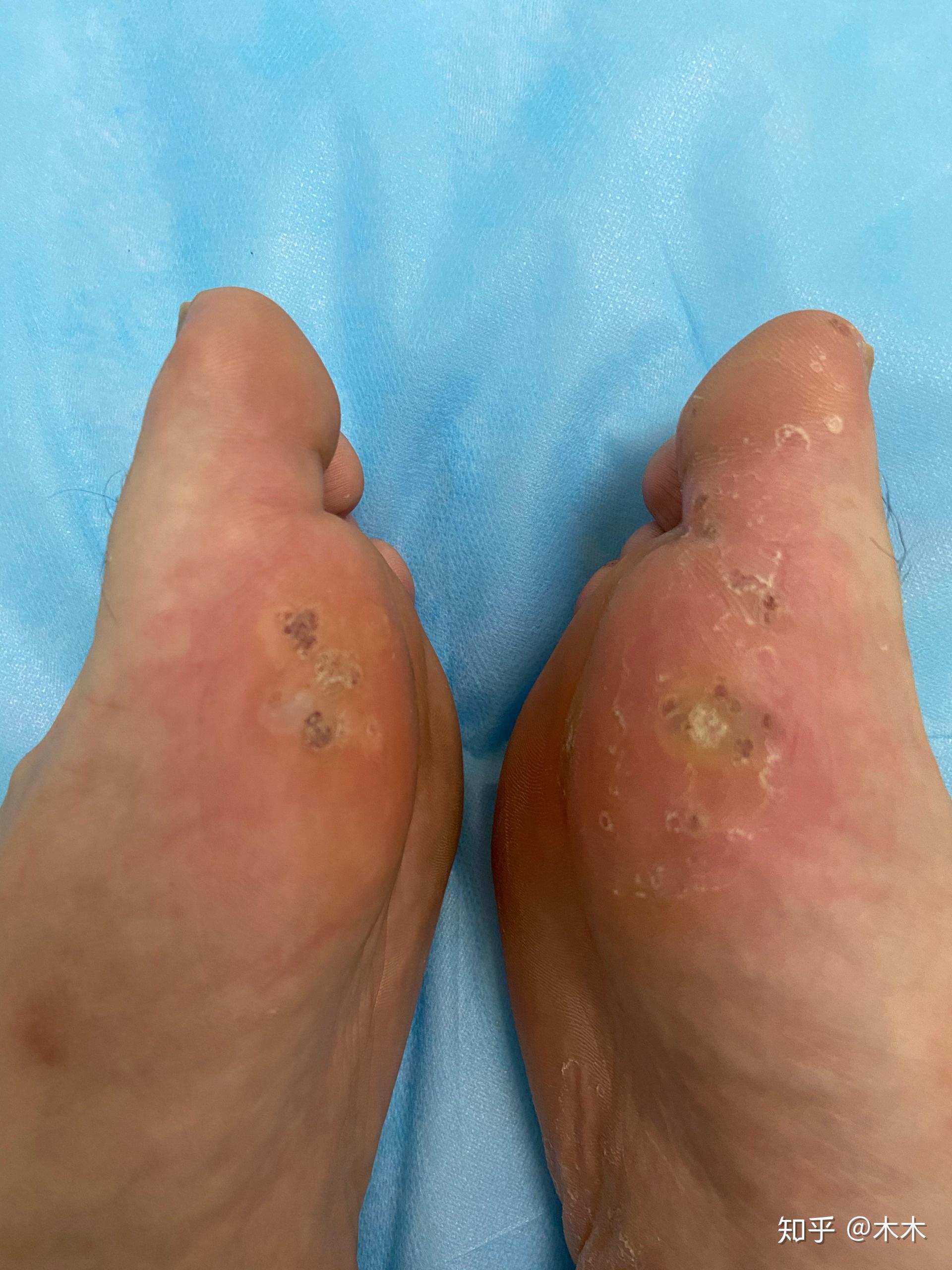 液氮冷冻治疗跖疣之路1